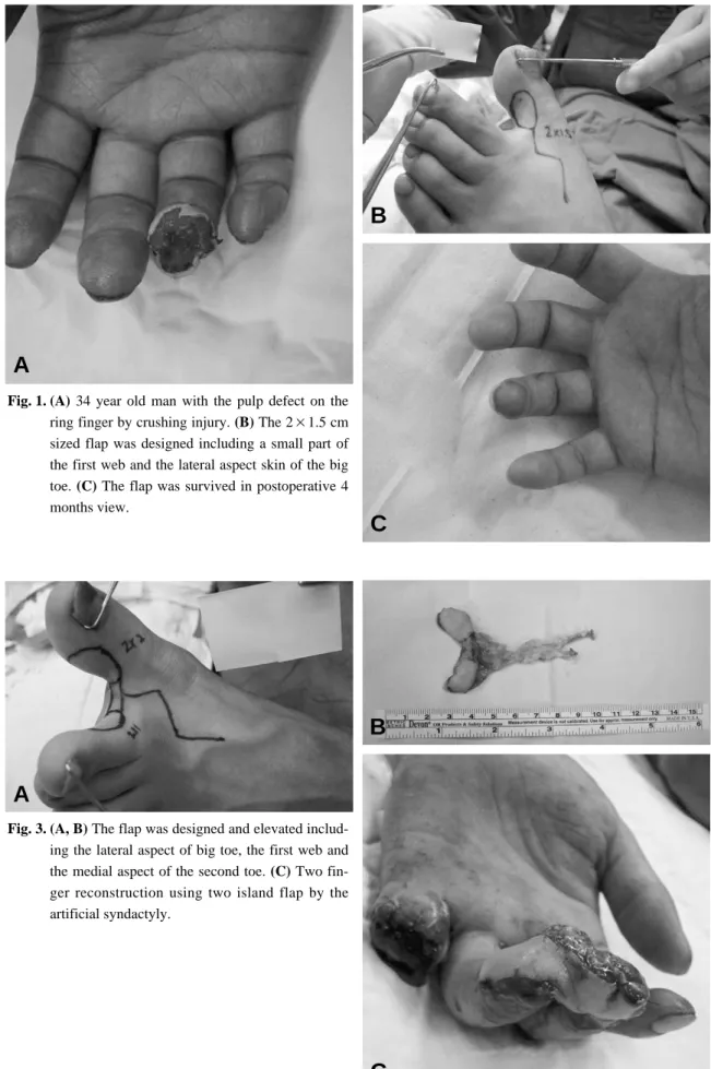 Fig. 1. (A)  34 year old man with the pulp defect on the ring finger by crushing injury