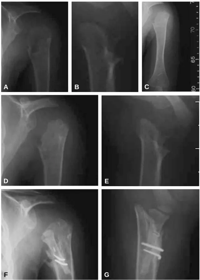 Fig. 1. (A) and (B) A 3 years old man with humeral head deformity as sequelae of septic arthritis