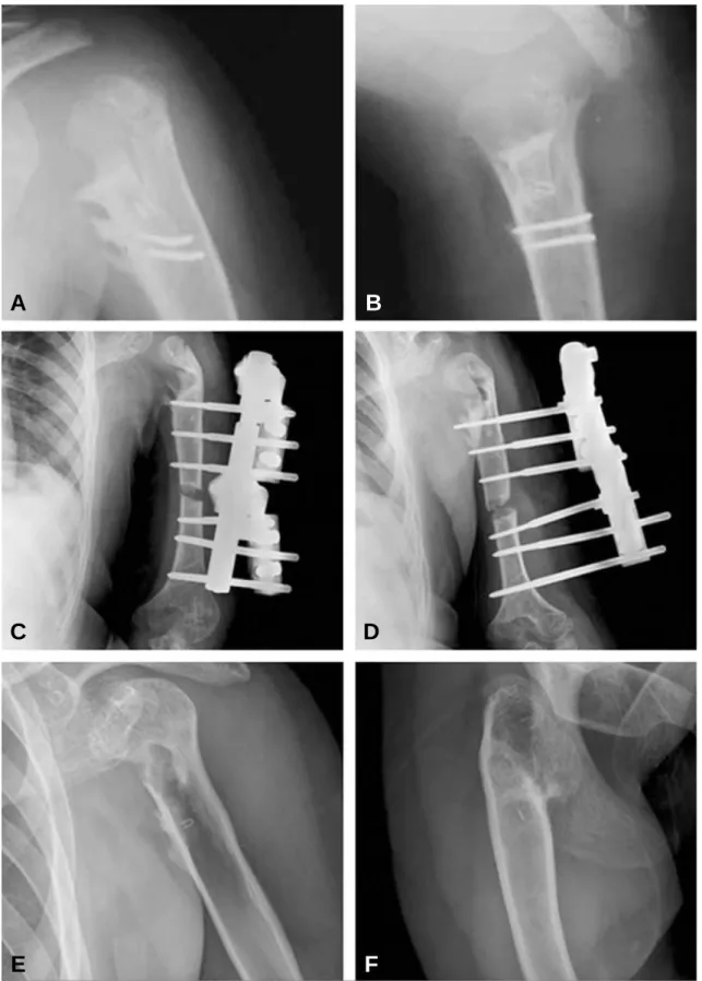 Fig. 2. (A) and (B) One year after surgery, bone union is obtained. (C) and (D) 6 years after surgery, humeral head deformity is improved but the discrepancy is 6cm