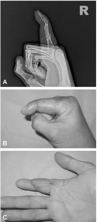 Fig. 2. On the trauma day, composite defective area was inserted with bone cement and fixated with k-wires after debridement.