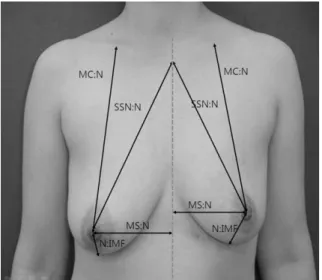 Fig. 2. Breast volume measurement was performed by the plaster casting method.