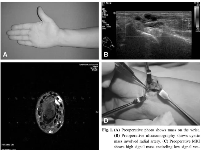 Fig. 1. (A) Preoperative photo shows mass on the wrist.