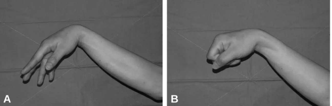 Fig. 1. (A, B) The patient could not extend the wrist and fingers at the first visit.