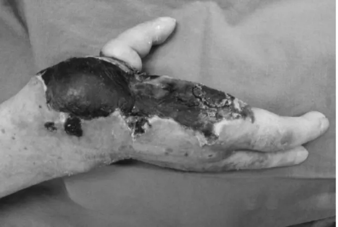 Fig. 2. Postoperative 1 month view, the skin and soft tissues around thumb was necrosed.