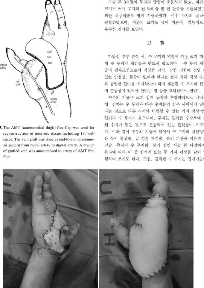 Fig. 4. Immediate postoperative view, show the defect was covered with AMT free flap completely.