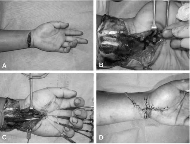Fig. 1. (A) A-26-year-old man who had been cutted with glass to his left wrist. (B) At exploration, 15 structures were found to be lacerated, including complete disruption of the FDP 2, 3, FDS 2-5, PL, FCU, median nerve, ulnar nerve, ulnar artery and incom