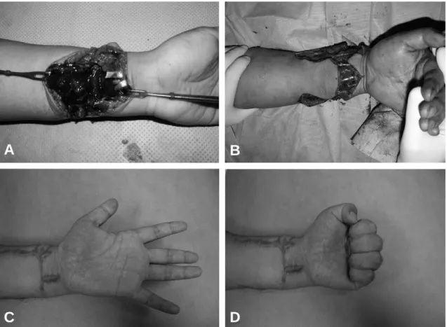 Fig. 2. (A) A-31-year-old man who had been cutted with knife to his left wrist. (B) At exploration, 16 structures were found to be lacerated, including complete disruption of the FPL, FDP 2-5, FDS 2-5, PL, FCR, FCU, median nerve, ulnar nerve, radial artery
