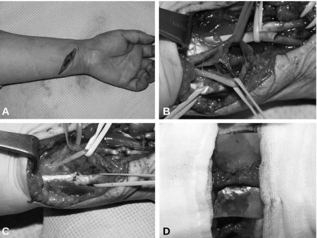 Fig. 3. (A) A-49-year-old female who had been cutted with knife to her left wrist. (B) Exploration revealed complete disruption of the PL and incomplete disruption of the FDS 2-4, FCU, median nerve