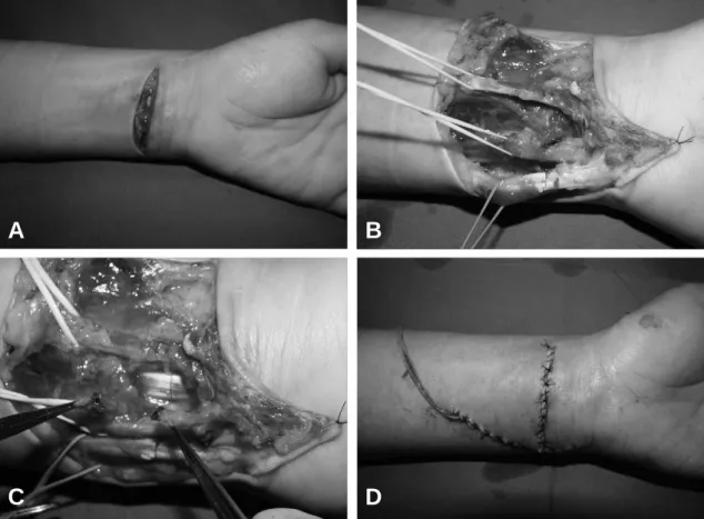 Fig. 4. (A) A-33-year-old female who had been cutted with knife to her left wrist. (B) Exploration revealed complete disruption of the PL, ulnar artery and incomplete disruption of the FDS 3, FCU, median nerve and ulnar nerve
