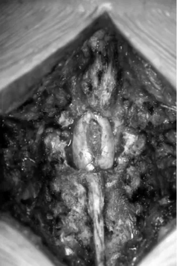 Fig. 3. Preoperative T2 MRI shows complete division of the spinal cord into two hemicords and the lower lying conus