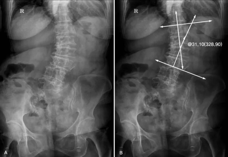 Fig. 1. (A, B) L-spine AP and Cobbs angle of 71 years olds female