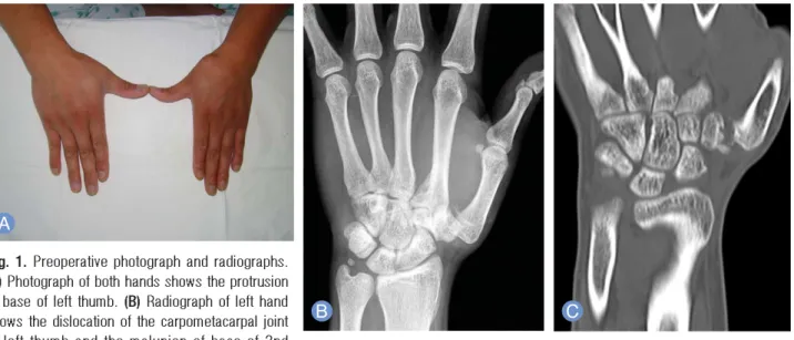 Fig. 2. Trapezial excision and ligament reconstruction tendon interposition arthroplasty was performed