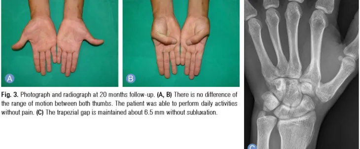 Fig. 3. Photograph and radiograph at 20 months follow-up. (A, B) There is no difference of the range of motion between both thumbs
