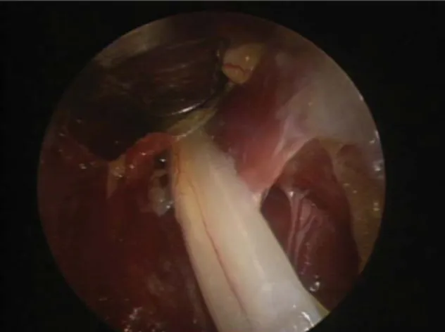 Fig. 3. Arthroscope sheath with retractor for endoscopic cubital tunnel release.