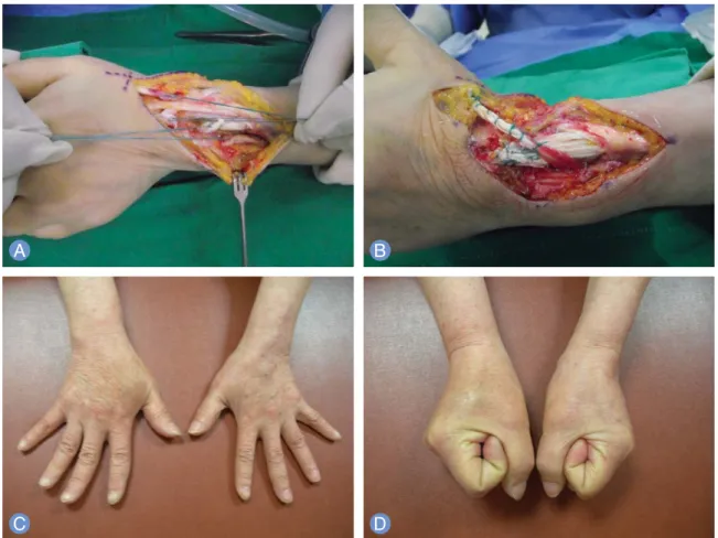 Fig. 1. (A) Intraoperative photography of a 44-year-old woman showed an old rupture of the extensor pollicis longus (EPL) with 5 cm intertendinous gap and extensor carpi radialis brevis (ECRB)