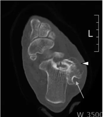 Figure 4. Intraoperative view of large, eccentrically located bony neoplasm resting on posterolateral aspect of the sinus tarsi
