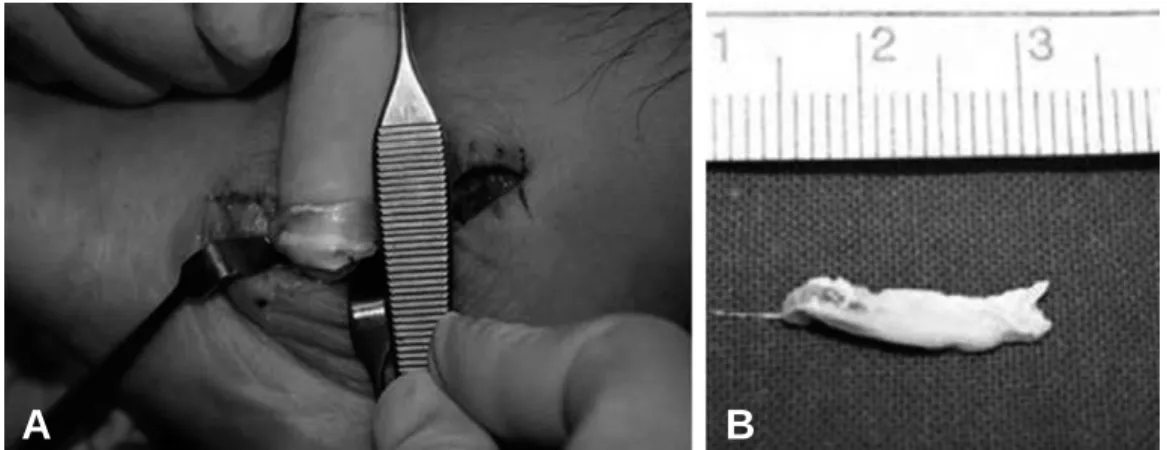 Figure 6. (A) Intraoperative view of the peroneus brevis tendon. (B) Excised some portion of peroneus brevis tendon with chalk-like deposits.