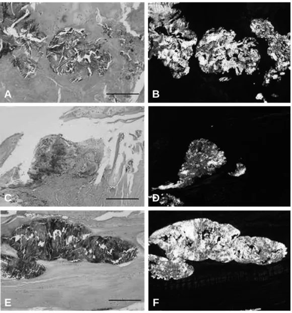 Figure 8. An aggregate of dissolved urate crystals is surrounded by reactive fibroblasts, mononuclear inflammatory cells.