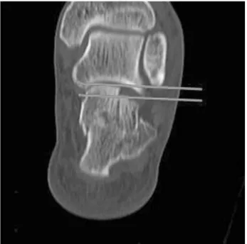 Figure 1. Preoperative CT semi-coronal image used for the radiological assessment of the joint depression.