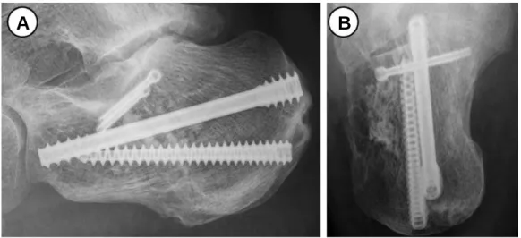 Figure 5. (A-B) Follow-up radiographs at postoperatively 1 year show the maintenance of subtalar joint alignment.