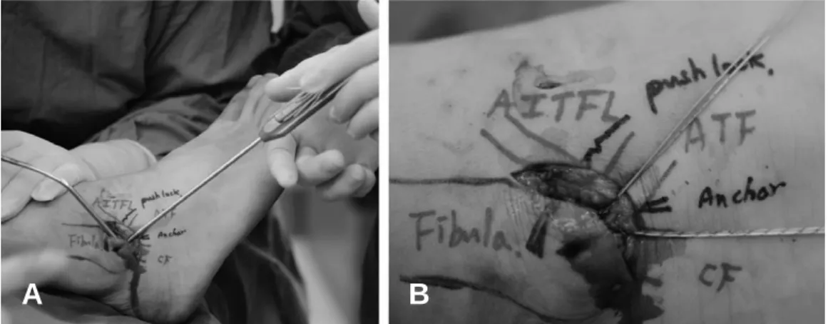 Figure 3. (A) Made a bone socket for PushLock anchor insertion (B) Passing the suture ends through the eyelet (C) Advance the PushLock into the bone socket, cut the suture ends with a blade