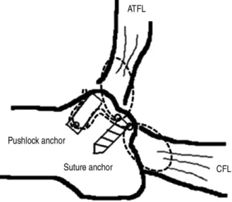 Figure 4. Schematic drawing of the operation