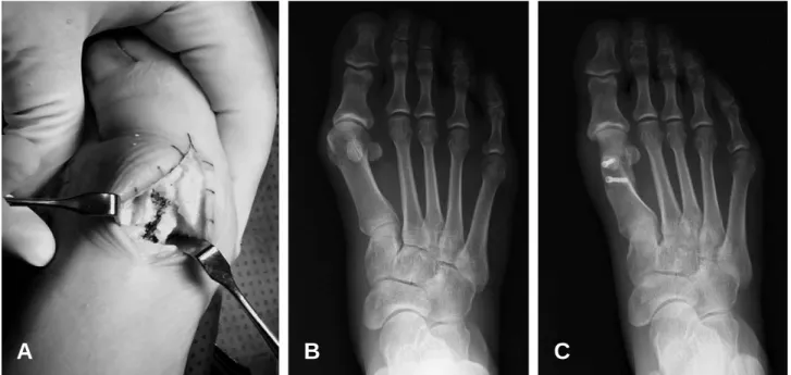 Figure 1. Photograph and plain radiographs of 41 year-old female patient. The skin incision was minimized to 15 mm to 20 mm and the scarf osteotomy that has short longitudinal cut was marked in line (A)