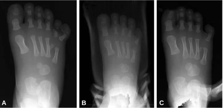 Figure 2. Simple radiograph of 1 year old male patient with postaxial polydactyly (A), immediate post operative radiograph showed complete excision of extradigit