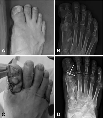 Figure 3. Photograph and radiograph of 60 years old female patient with right foot preaxial polydactyly consisit of distal phalanx duplication (A,  B)