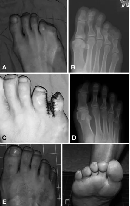 Figure 4. Photograph and radiograph of 57 years old female patient with post-axial polysyndactyly (A, B)