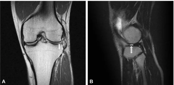 Fig. 2. A arthroscopic view showed a complete radial tear in the midbody of the lateral meniscus resembling a cyclops lesion extending to the peripheral  meniscocap-sular junction.