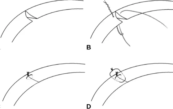 Fig. 5. An arthroscopic view 6 months after index surgery showed smoothing at the free edge of the saucerized meniscus and connecting tissue at the previous tear site.