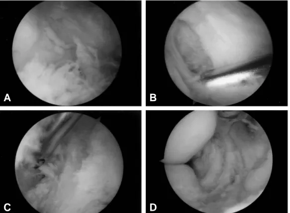 Fig. 3. (A) An arthroscopic view shows synovial proliferation at posteromedial compartment