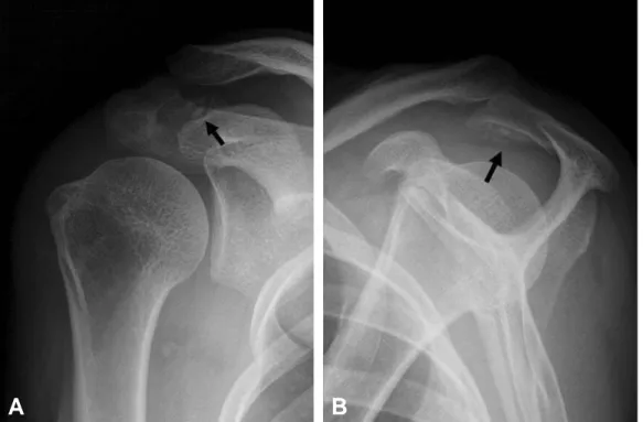 Fig. 1. The preoperative right shoulder (A) anteroposterior and (B) lateral radiograph demonstrates radio-opaque loose bodies (black arrow) in the subacromial space and subdeltoidal area.