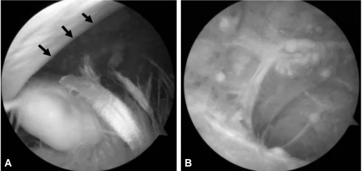 Fig. 3. (A) Arthroscopic finding reveals the chondroid loose body in subacromial space and (B) the budding of synovium