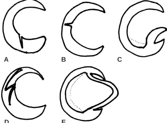 Fig. 1. Illustration of meniscus tear classified shape. (A) Oblique tear, (B) Radial tear, (C) Flap tear, (D) Complex tear, (E) bucket handle tear