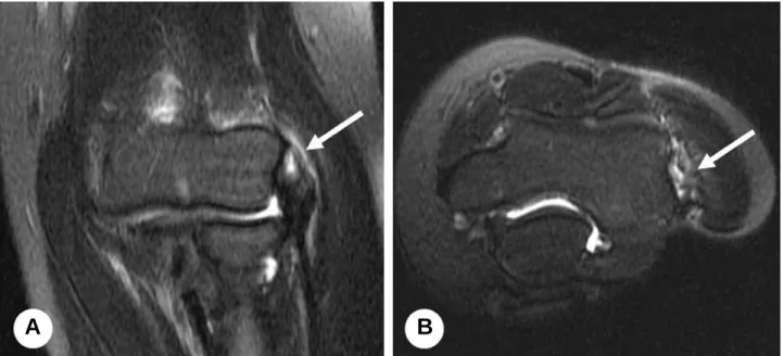Fig. 1. T2-weighted (A) coronal and (B) axial magnetic resonance imaging shows a high signal focus (white arrow) in the extensor carpi radialis brevis (ECRB) tendon at the lateral epicondyle.