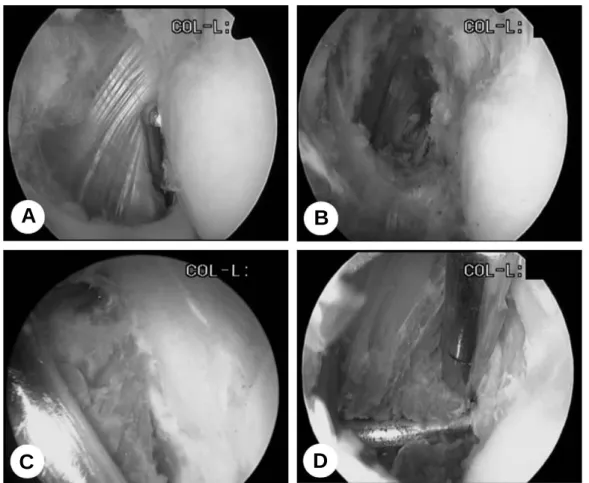 Fig. 3. Arthroscopic photographs depicting the step of procedure for extensor carpi radialis brevis (ECRB) release of the right elbow show (A) ECRB tendon origin after release of capsule and (B) the release of tendon origin