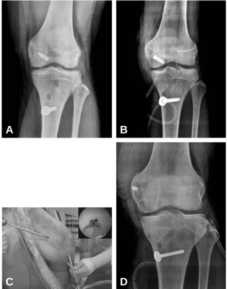 Fig. 1. (A,  B) Femoral fixation methods of Achilles tendon allograft with metal interference screw is showing with (A) inside-out method, and (B) modified outside-in method