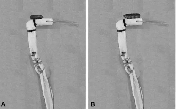 Fig. 3. (A) Schematic view of inside-out method and (B) modified outside-in method of femoral fixation of the metal interference screw is showing.