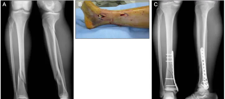 Figure 1. Minimally invasive plate osteosynthesis. (A) Preoperative radiographs show a distal tibial fracture