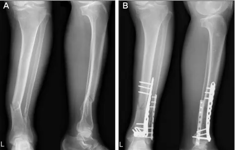 Figure 2. Conventional open reduction and  anterolateral plate fixation. (A) Preoperative  radiographs show a commintued distal tibial  fracture