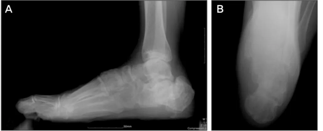 Figure 2. (A) W eight-bearing lateral  radiograph of a patient with calcaneal  malunion demonstrating loss of height,  decreased calcaneal pitch, diminished  talocalcaneal angle