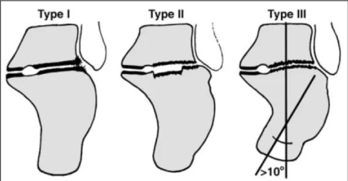 Figure 3. Stephens and Sanders CT classification of calcaneal malunion.