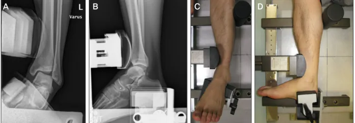 Figure 1. Ankle varus stress view and anterior drawer test were performed with Telos Device at 20N.