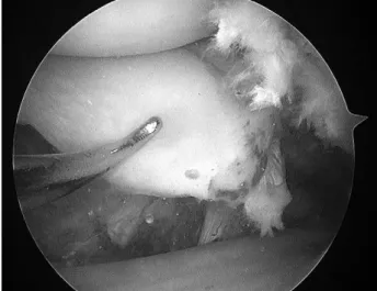 Fig. 8. (A) One 5.0 mm suture anchor (Smith &amp; Nephew Inc., Andover, MA, USA) is inserted to the tibial attachment site of the pos- pos-terior root of medial meniscus