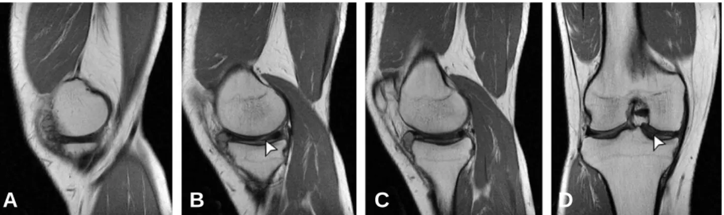 Fig. 6. Arthroscopy of the right knee. (A) Incomplete type medial discoid meniscus with radial tear, obscuring the underlying tibial plateau incompletely