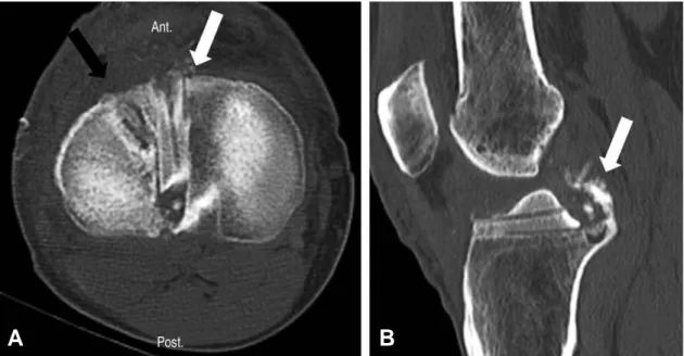 Fig. 3. A bucket handle meniscal tear lateral meniscus was showed (A) in mid-coronal view of postoperative magnetic resonance imaging in a right knee (black arrow), and (B) in Arthroscopy.
