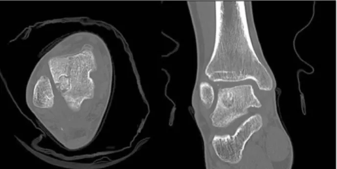 Fig. 4. Postoperative 3 months follow-up coronal computed tomography (CT) of right ankle showing incorporation of the bone graft.