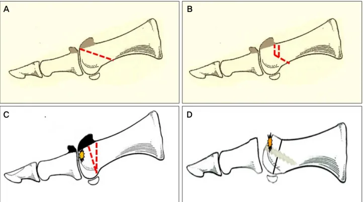 Figure 5. Schematic drawing show representive metatarsal osteotomies for hallux rigidus